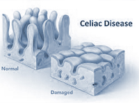 Celiachia