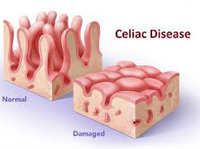 Celiachia